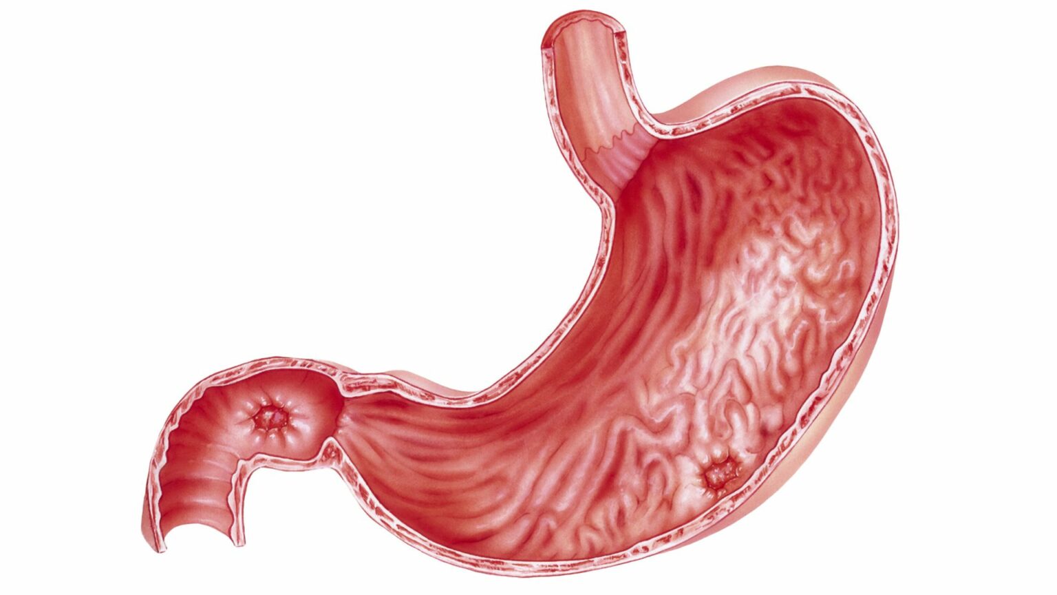 Can Stomach Ulcers Lead to Stomach Cancer